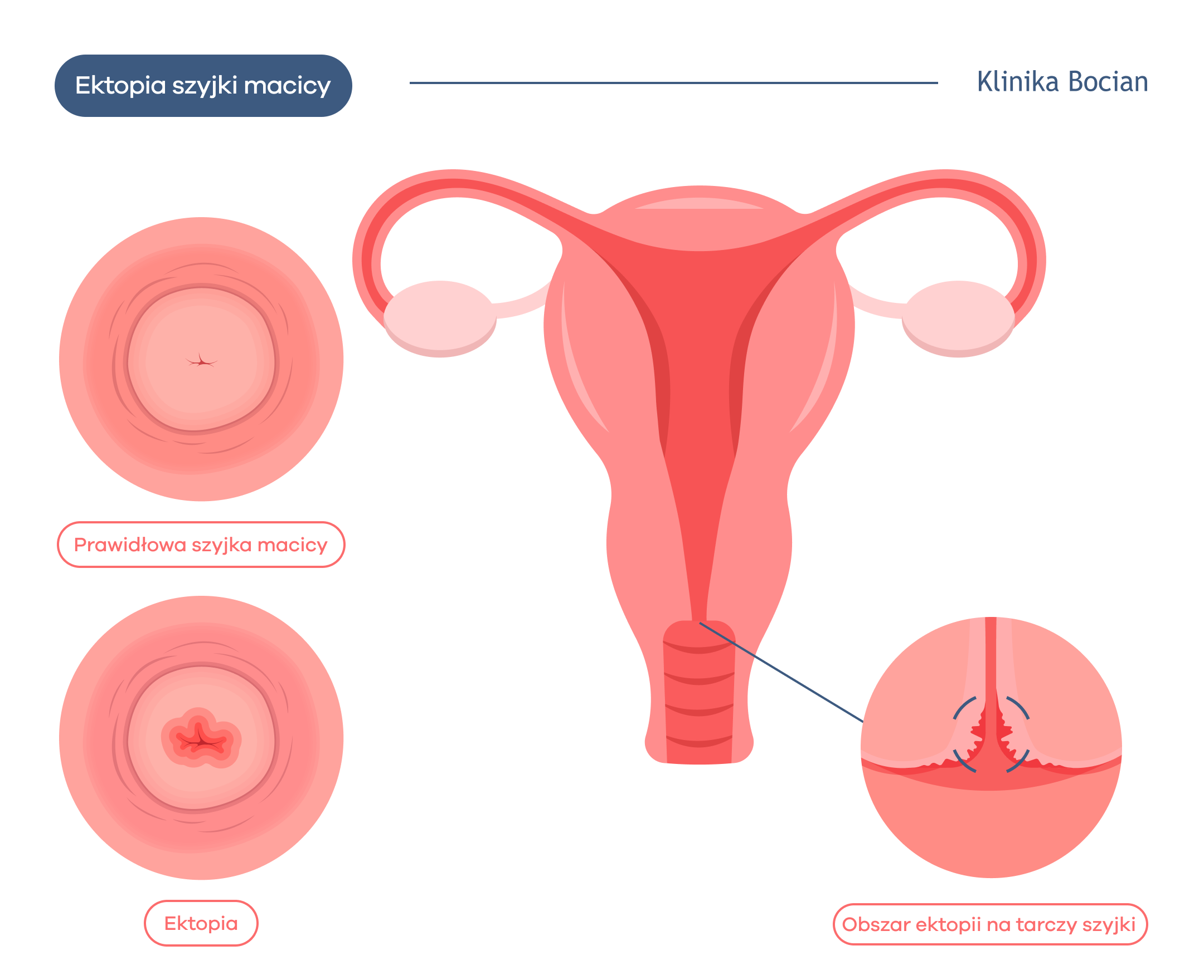 Nadżerka szyjki macicy