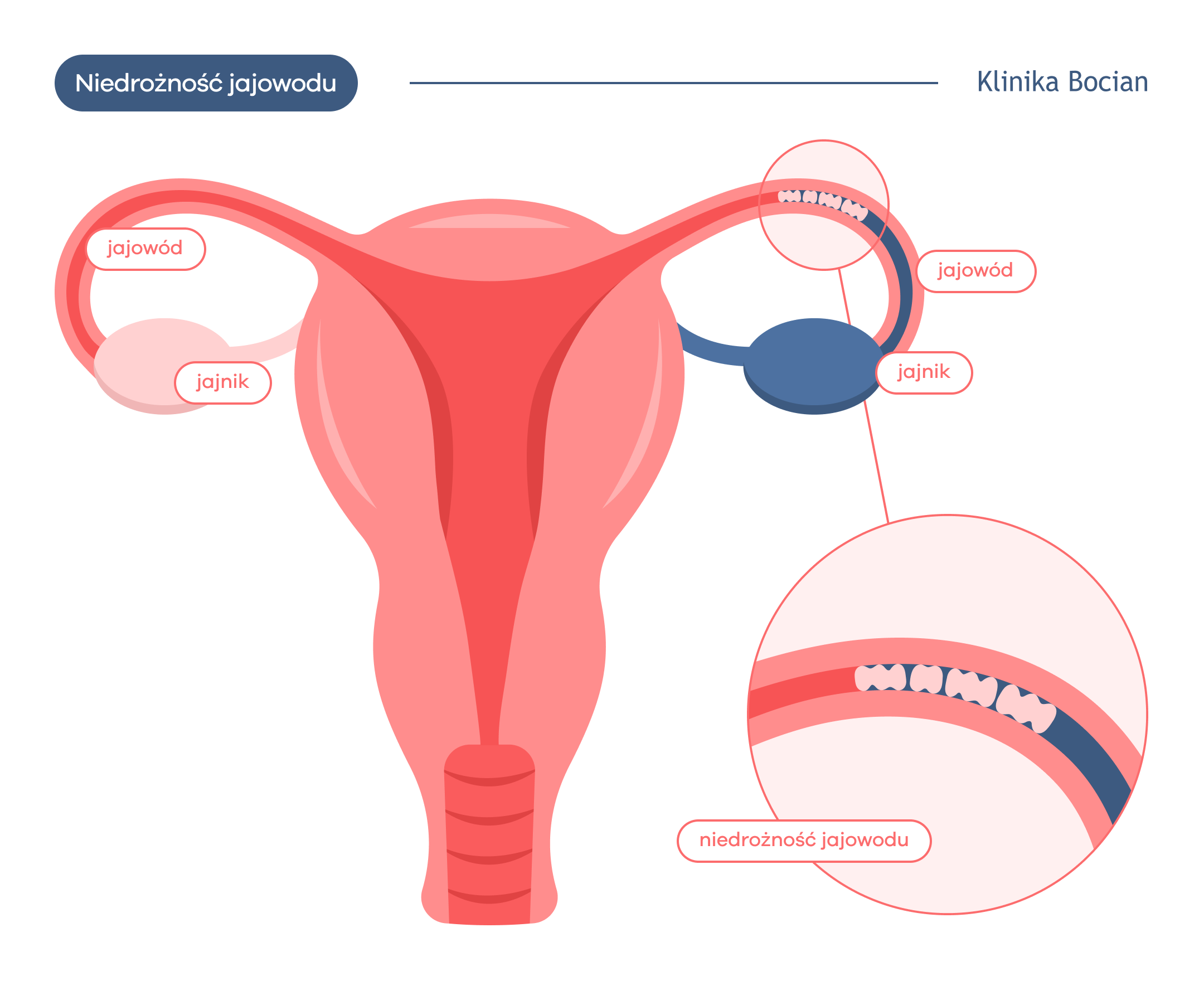 Czym jest niedrożność jajowodu?
