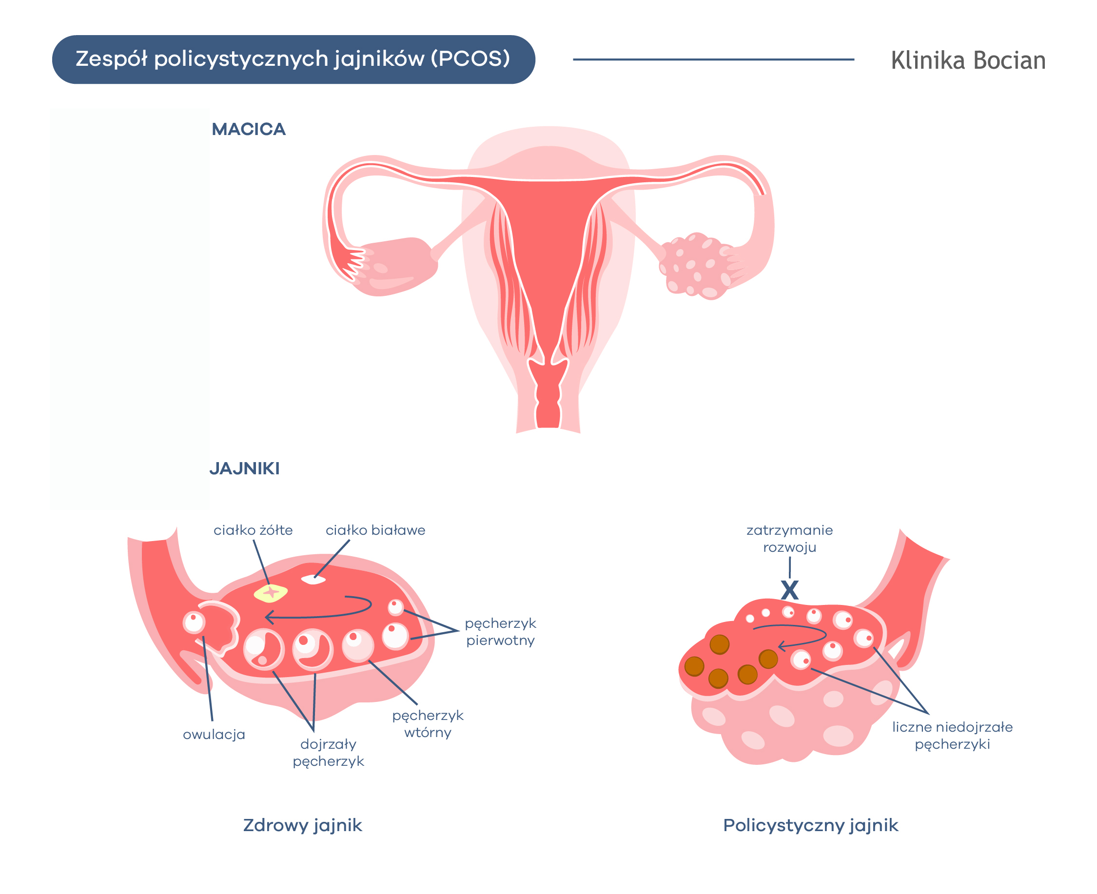 Zespół policystycznych jajników (PCOS)