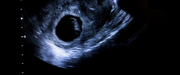 Ein In vitro - Verfahren in einer Kinderwunschklinik in Polen und Embryoentwicklung nach dem Transfer